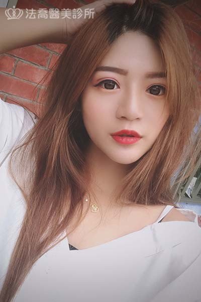 自體肋骨隆鼻