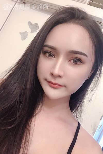 自體肋骨隆鼻