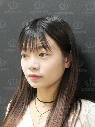 法喬醫美診所_自體肋骨客製化隆鼻