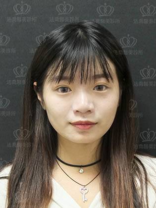 法喬醫美診所_自體肋骨客製化隆鼻