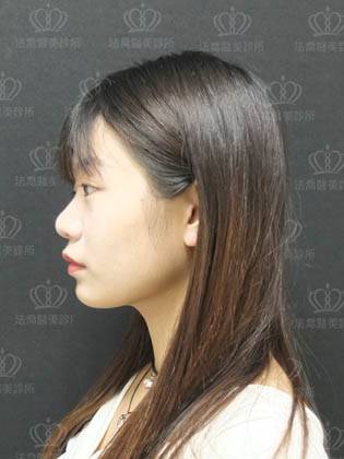 法喬醫美診所_自體肋骨客製化隆鼻