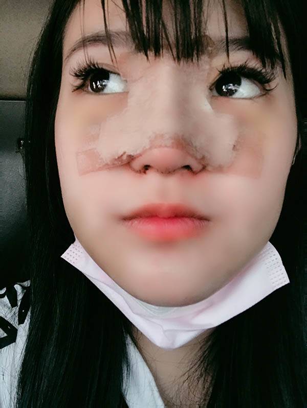 法喬醫美診所_自體肋骨隆鼻術後五天