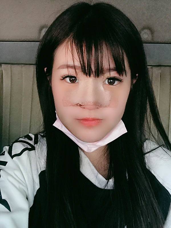 法喬醫美診所_自體肋骨隆鼻術後5天