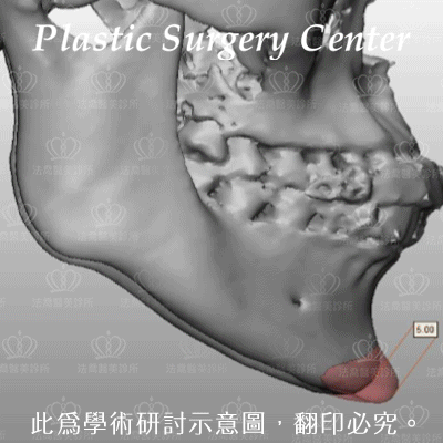 法喬醫美診所_骨水泥下巴模擬+斷層掃描