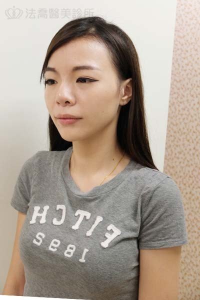 自體肋骨隆鼻