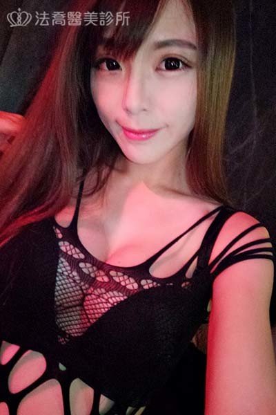 自體肋骨隆鼻
