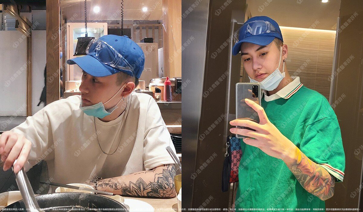 自體肋骨隆鼻,法喬醫美診所,邱浚彥
