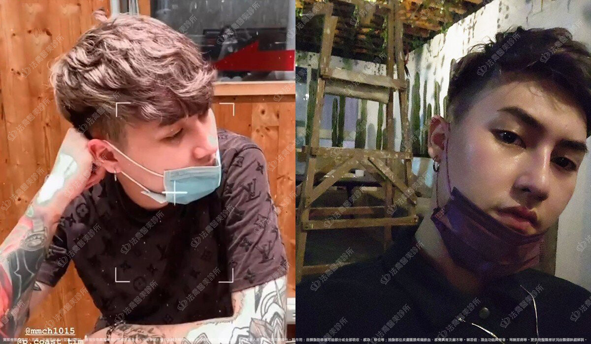 自體肋骨隆鼻,法喬醫美診所,邱浚彥