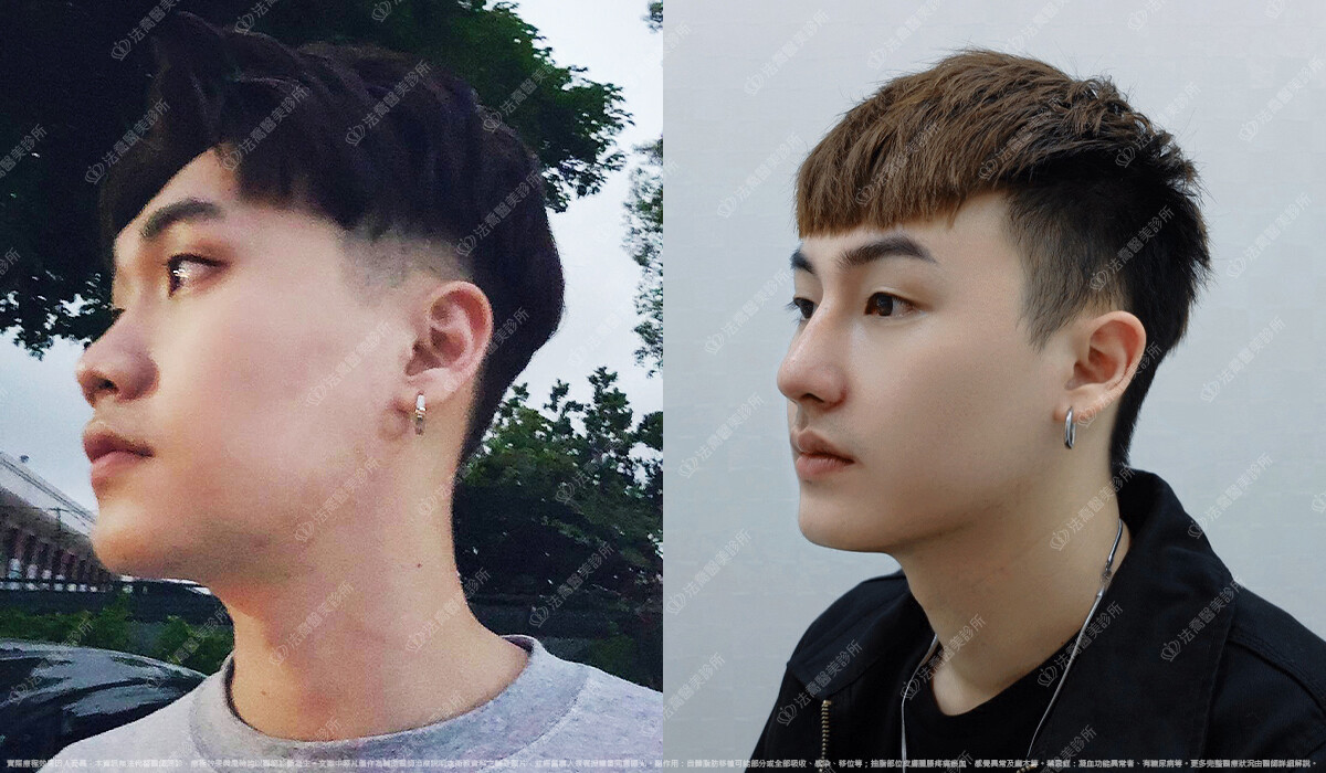 自體肋骨隆鼻,法喬醫美診所,邱浚彥