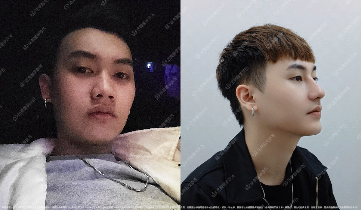 自體肋骨隆鼻,法喬醫美診所,邱浚彥