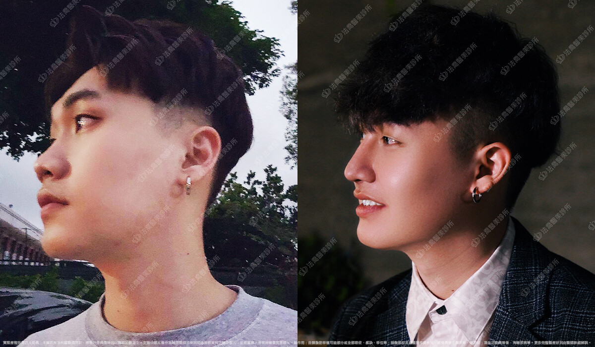 法喬醫美診所,邱浚彥,自體肋骨隆鼻,隆鼻推薦