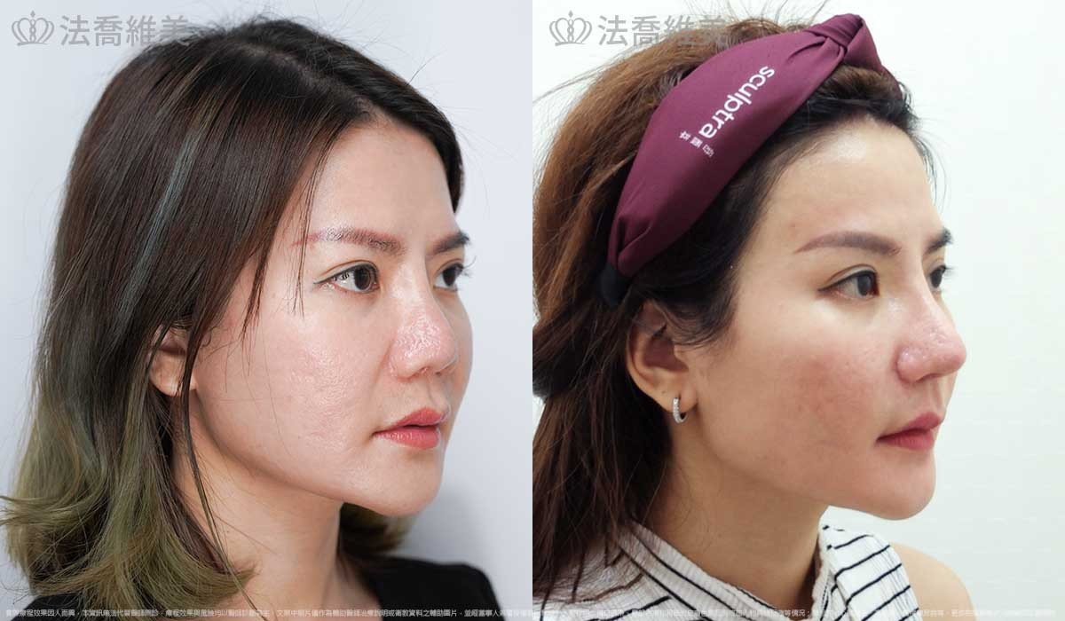 法喬醫美診所邱浚彥醫師縮鼻翼鼻頭雕塑案例