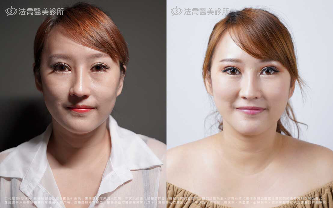 臉頰凹陷