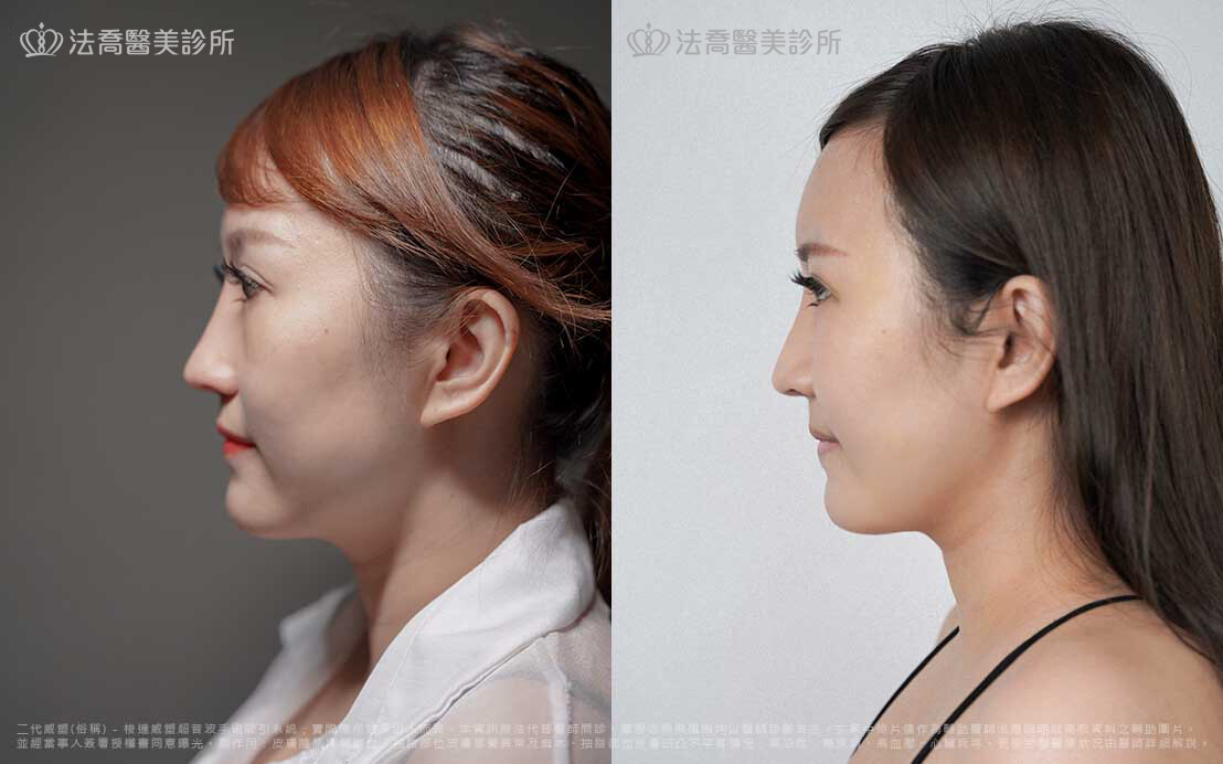 補臉