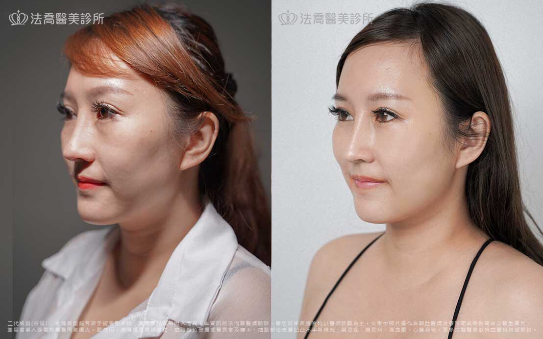 抽脂手術