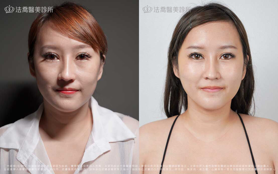 自體脂肪豐臉