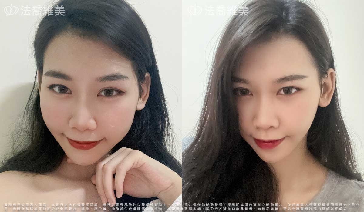 平平自體脂肪豐臉術後3個月生活照