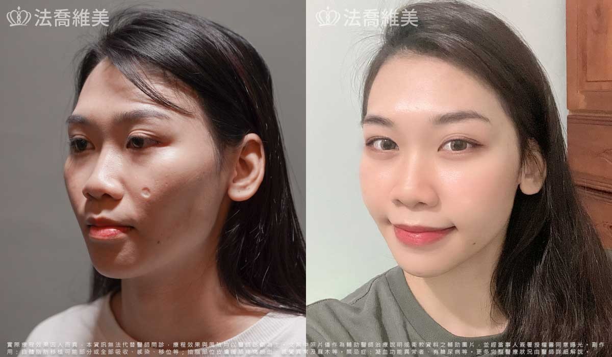 平平自體脂肪豐臉(術後3個月)3