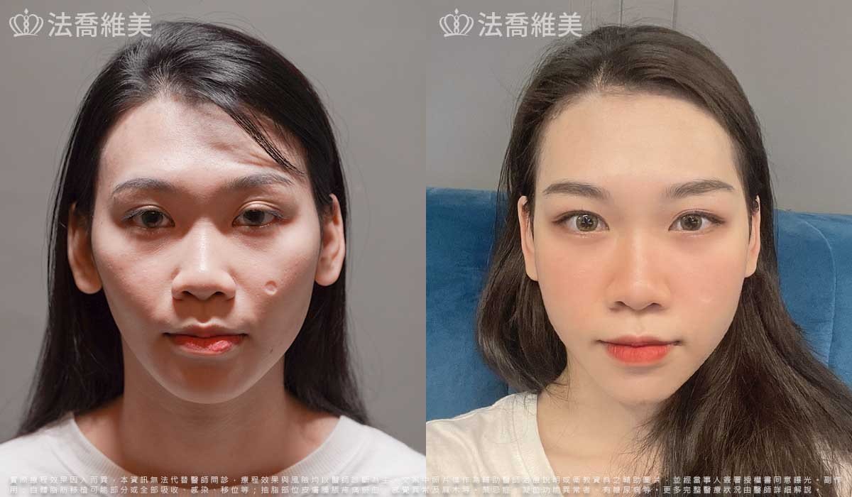 平平自體脂肪豐臉(術後3個月)1