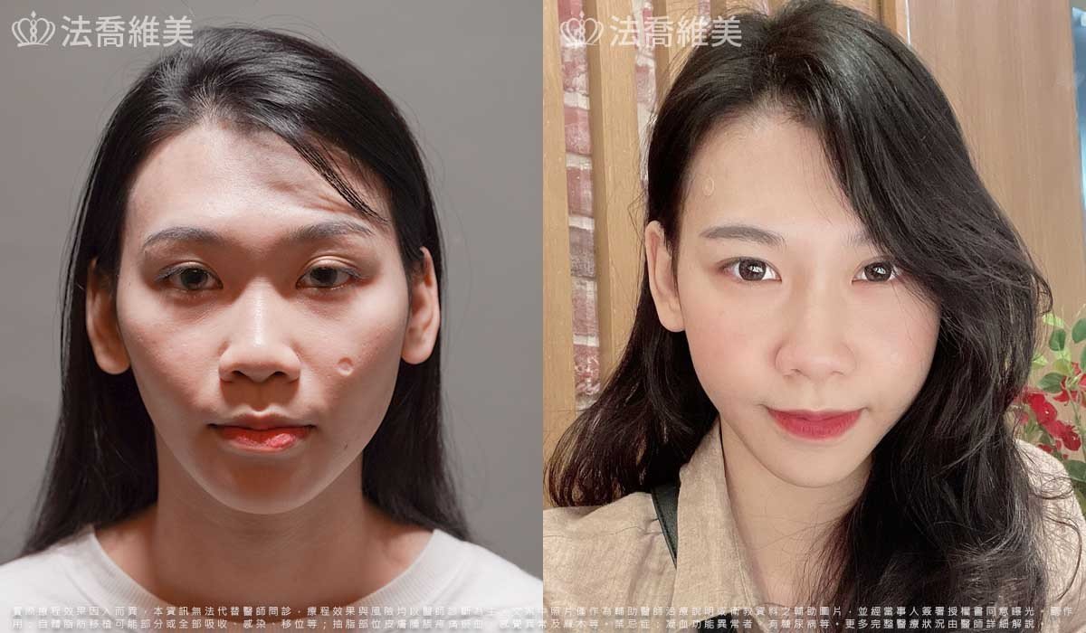 平平自體脂肪豐臉(術後1個月)