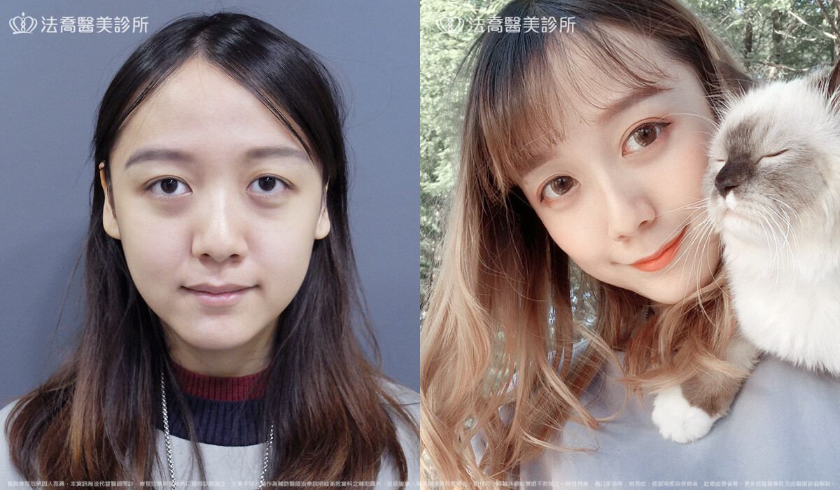 眼袋內開