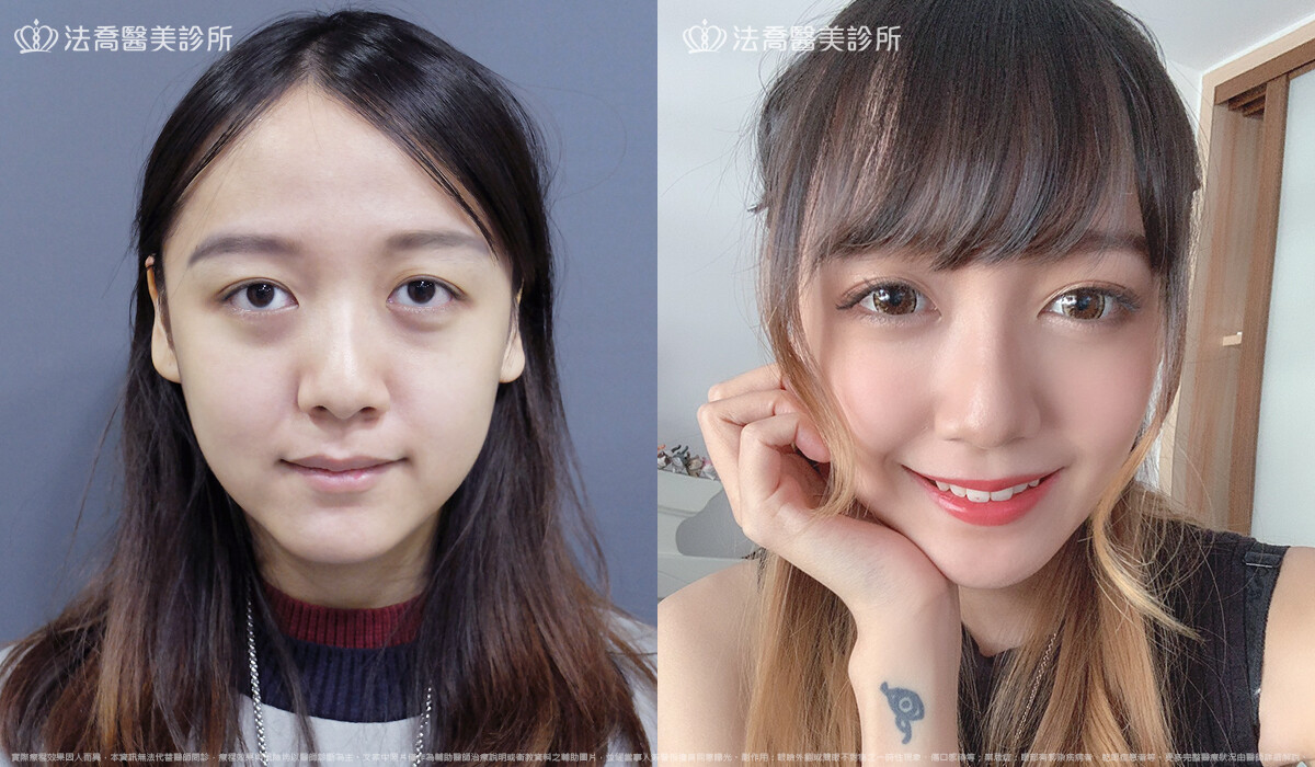 眼部手術