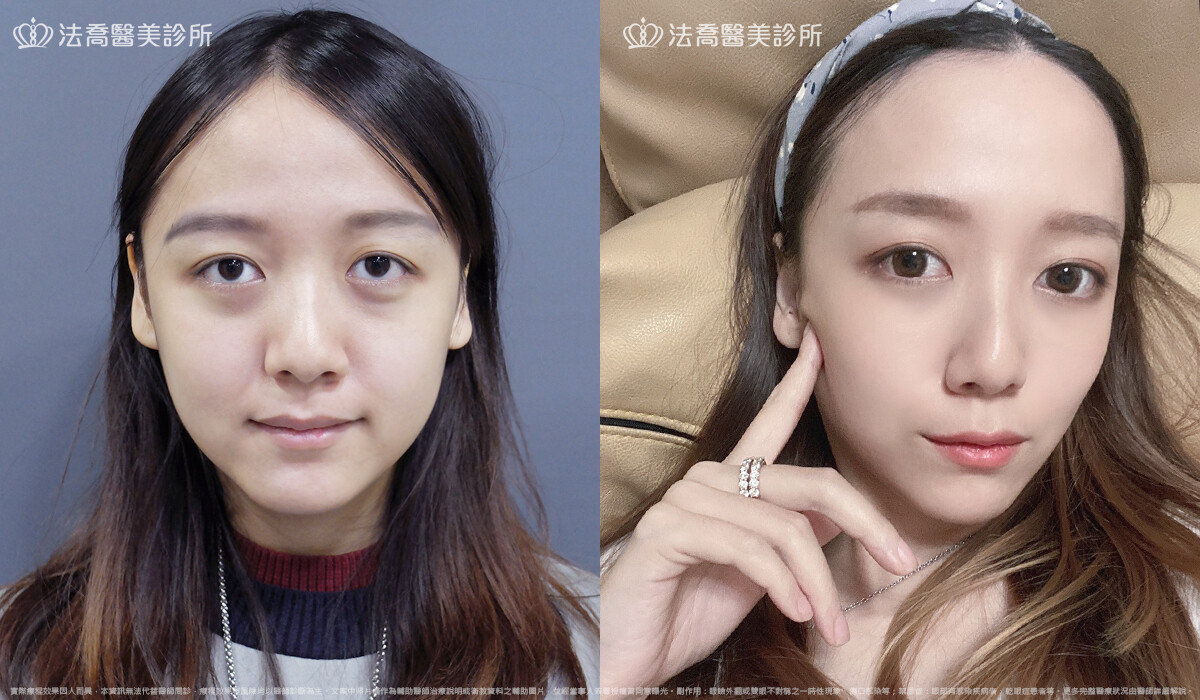 眼袋