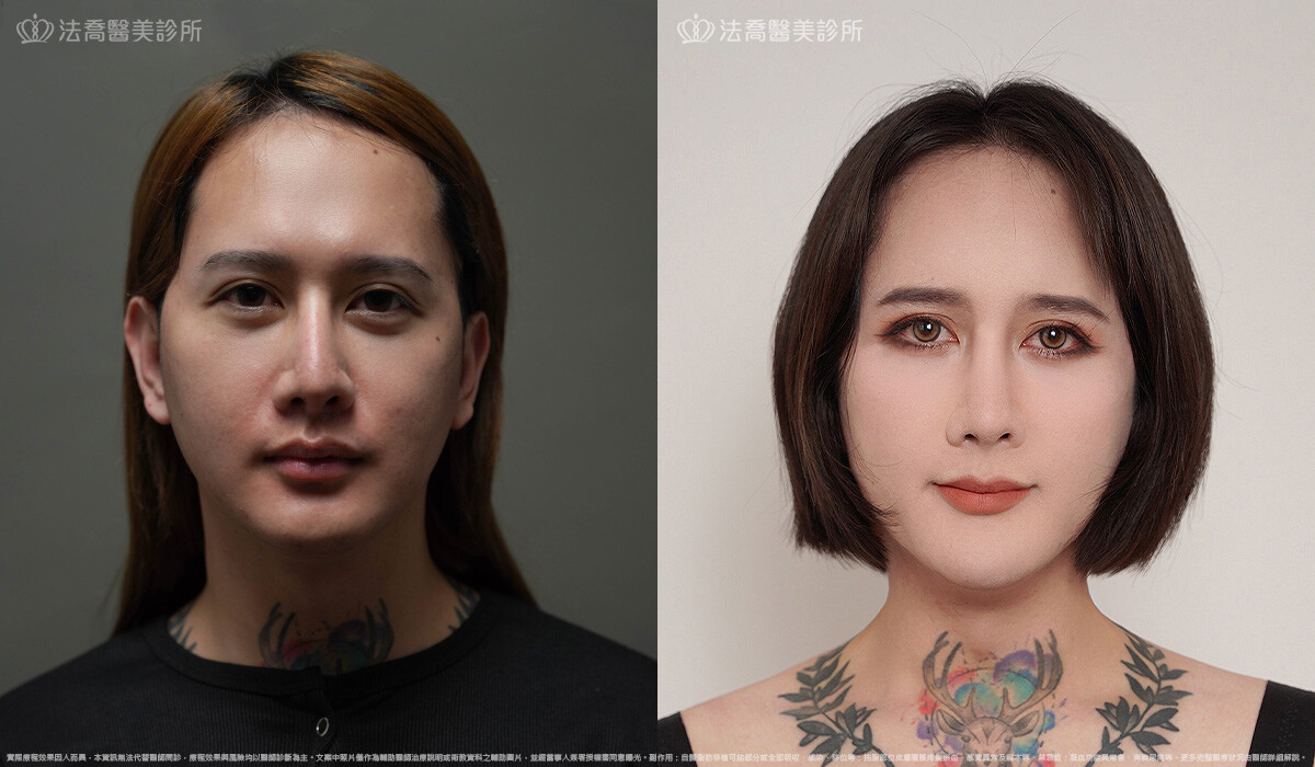 自體脂肪豐臉