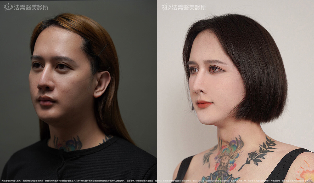 脂肪豐臉