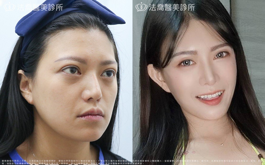 高雄法喬醫美,邱浚彥,威塑抽脂,自體脂肪豐臉