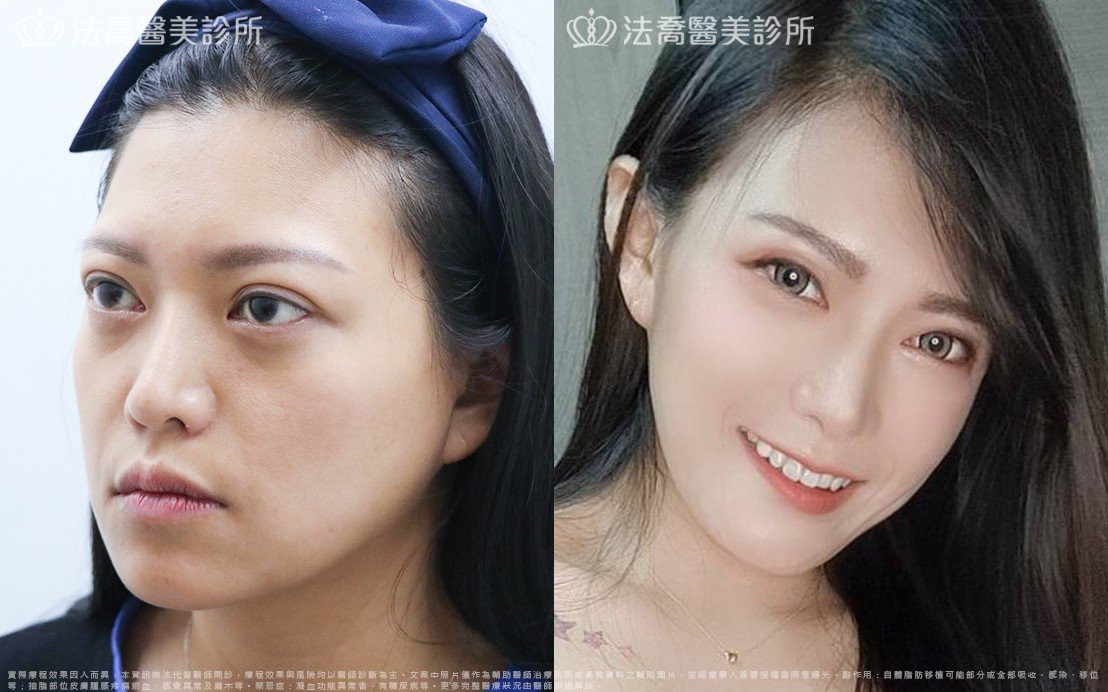 高雄法喬醫美,邱浚彥,威塑抽脂,自體脂肪豐臉