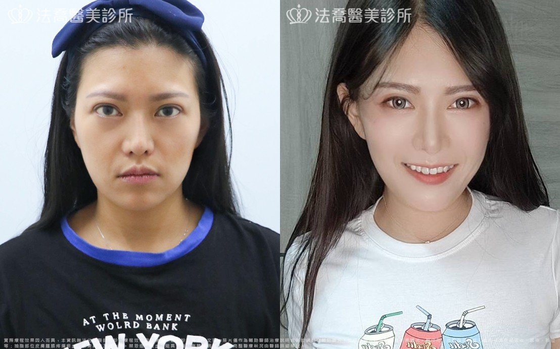 高雄法喬醫美,邱浚彥,威塑抽脂,自體脂肪豐臉