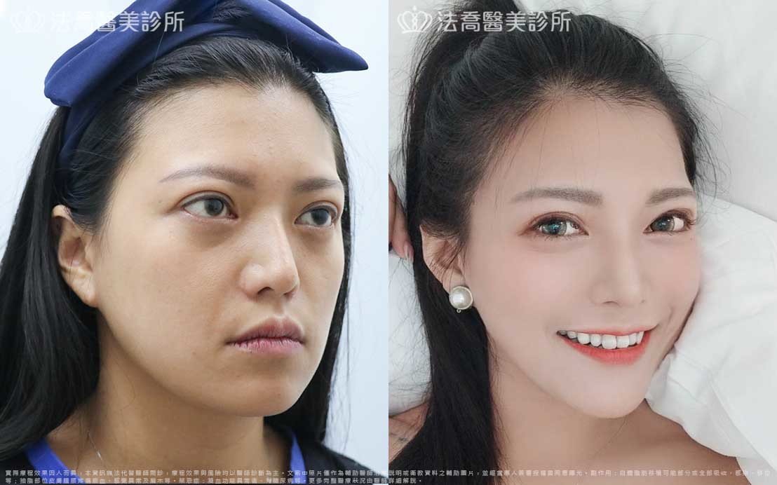 高雄法喬醫美,邱浚彥,威塑抽脂,自體脂肪豐臉