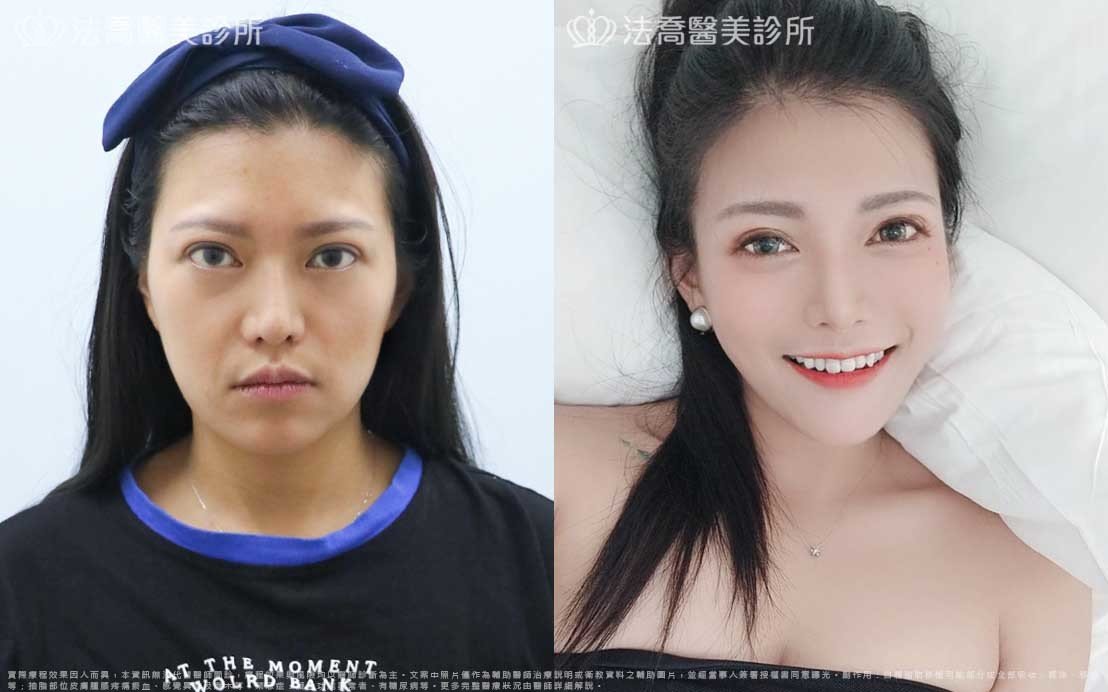 高雄法喬醫美,邱浚彥,威塑抽脂,自體脂肪豐臉