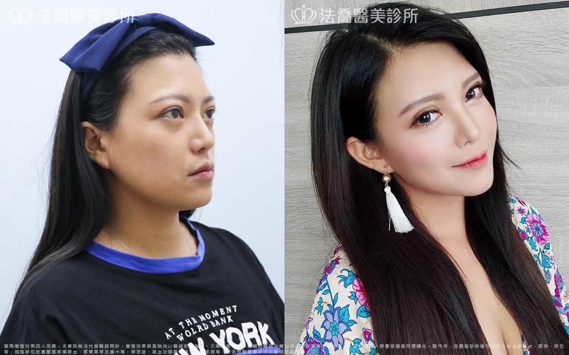 高雄法喬醫美,邱浚彥,威塑抽脂,自體脂肪豐臉