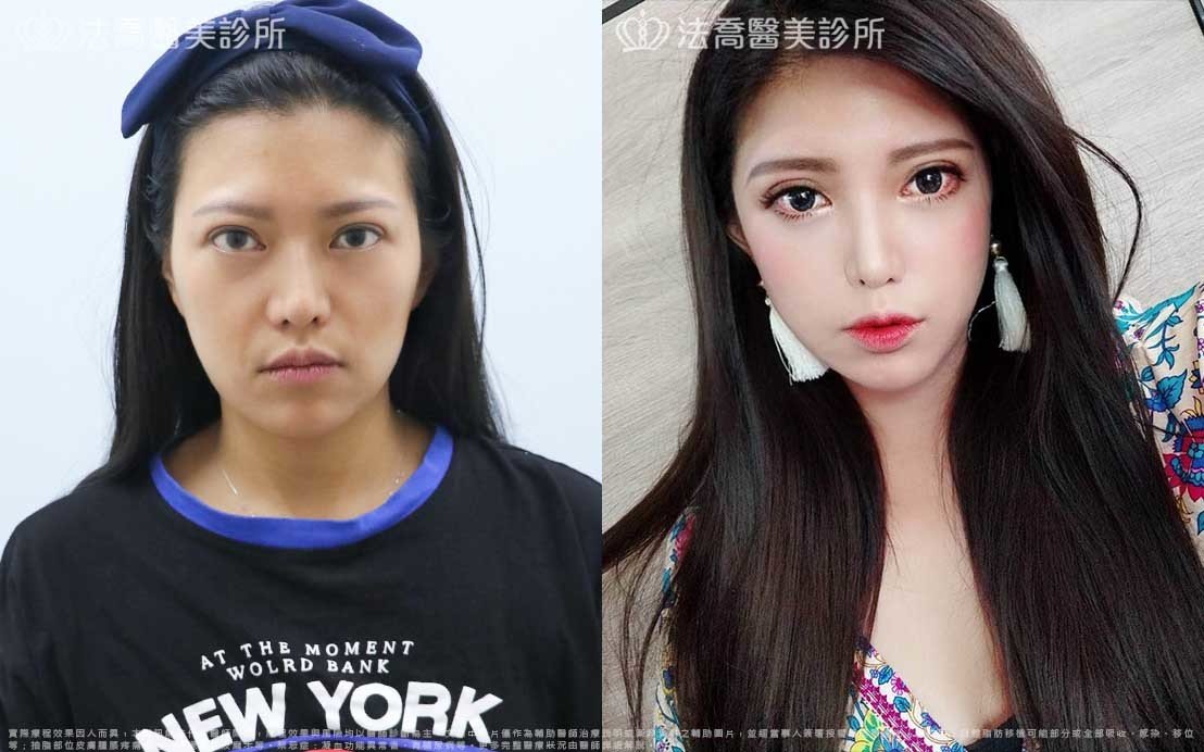 高雄法喬醫美,邱浚彥,威塑抽脂,自體脂肪豐臉