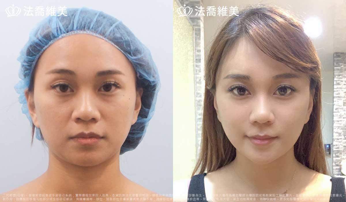 高雄法喬醫美,邱浚彥,威塑抽脂,自體脂肪豐臉
