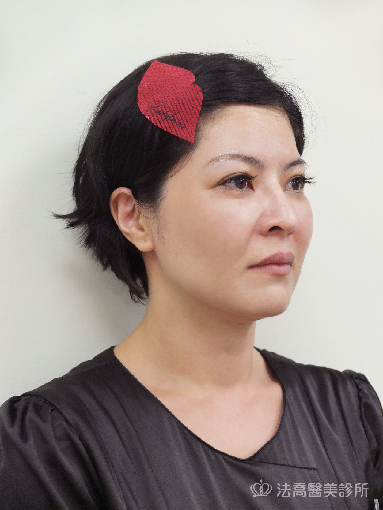 /files/images/案例分享/自體脂肪移植/LINGANA/高臺霙-術前生活照-補_191115_0005.jpg?1573829233 法喬醫美診所-自體脂肪術前照