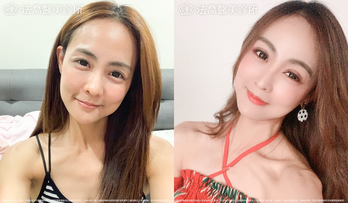 自體脂肪豐全臉,法喬醫美診所,邱浚彥