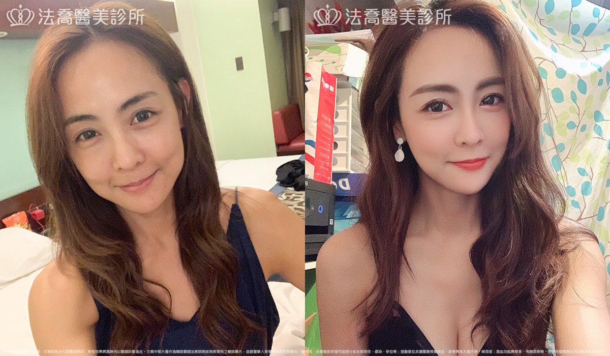自體脂肪豐全臉,法喬醫美診所,邱浚彥