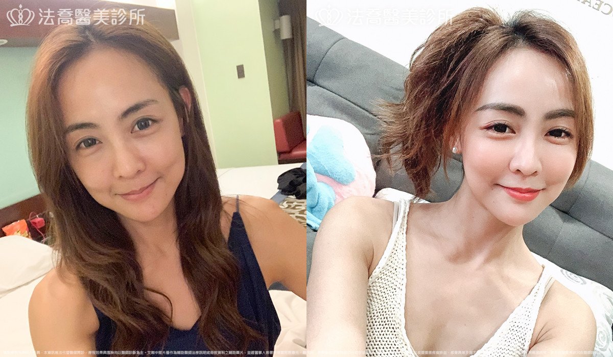 自體脂肪豐全臉,法喬醫美診所,邱浚彥