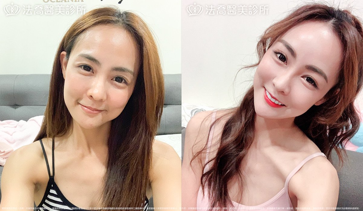 自體脂肪豐全臉,法喬醫美診所,邱浚彥