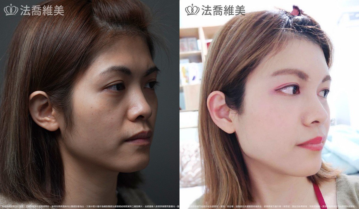 脂肪豐臉