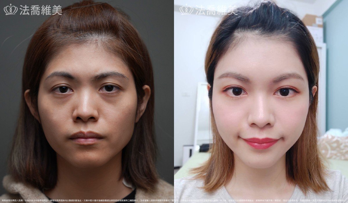 隆鼻推薦