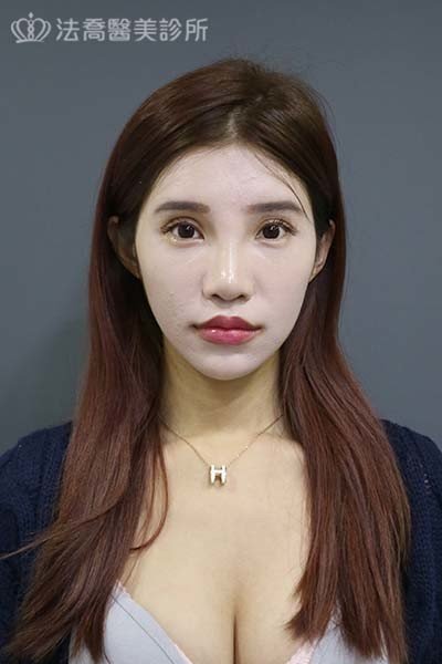 自體肋骨隆鼻
