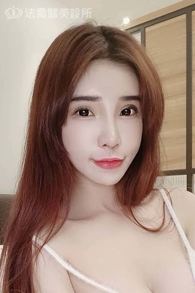 自體肋骨隆鼻