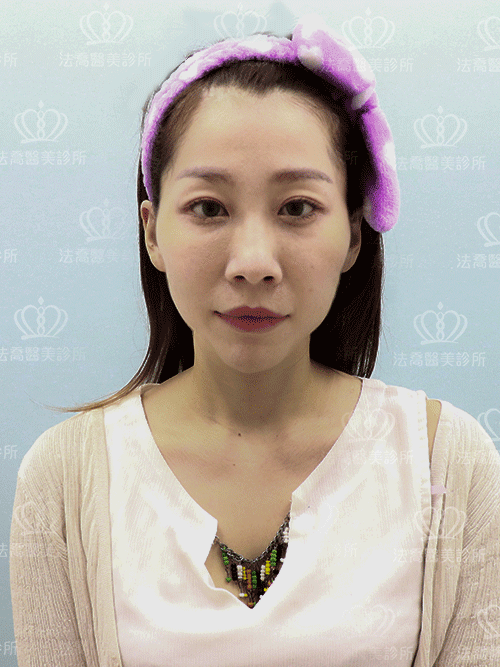 法喬醫美診所脂肪精雕權威唐文瑞醫師精雕細琢術前照