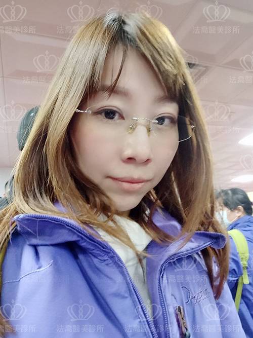 /files/images/案例分享/自體脂肪移植/LINGANA/高臺霙-術前生活照-補_191115_0005.jpg?1573829233 法喬醫美診所-自體脂肪術前照