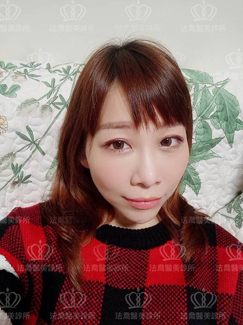 /files/images/案例分享/自體脂肪移植/LINGANA/高臺霙-術前生活照-補_191115_0007.jpg?1573829234 法喬醫美診所-自體脂肪術前照