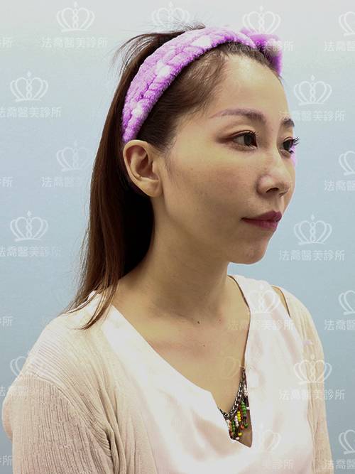 法喬醫美診所脂肪精雕權威唐文瑞醫師精雕細琢術前照